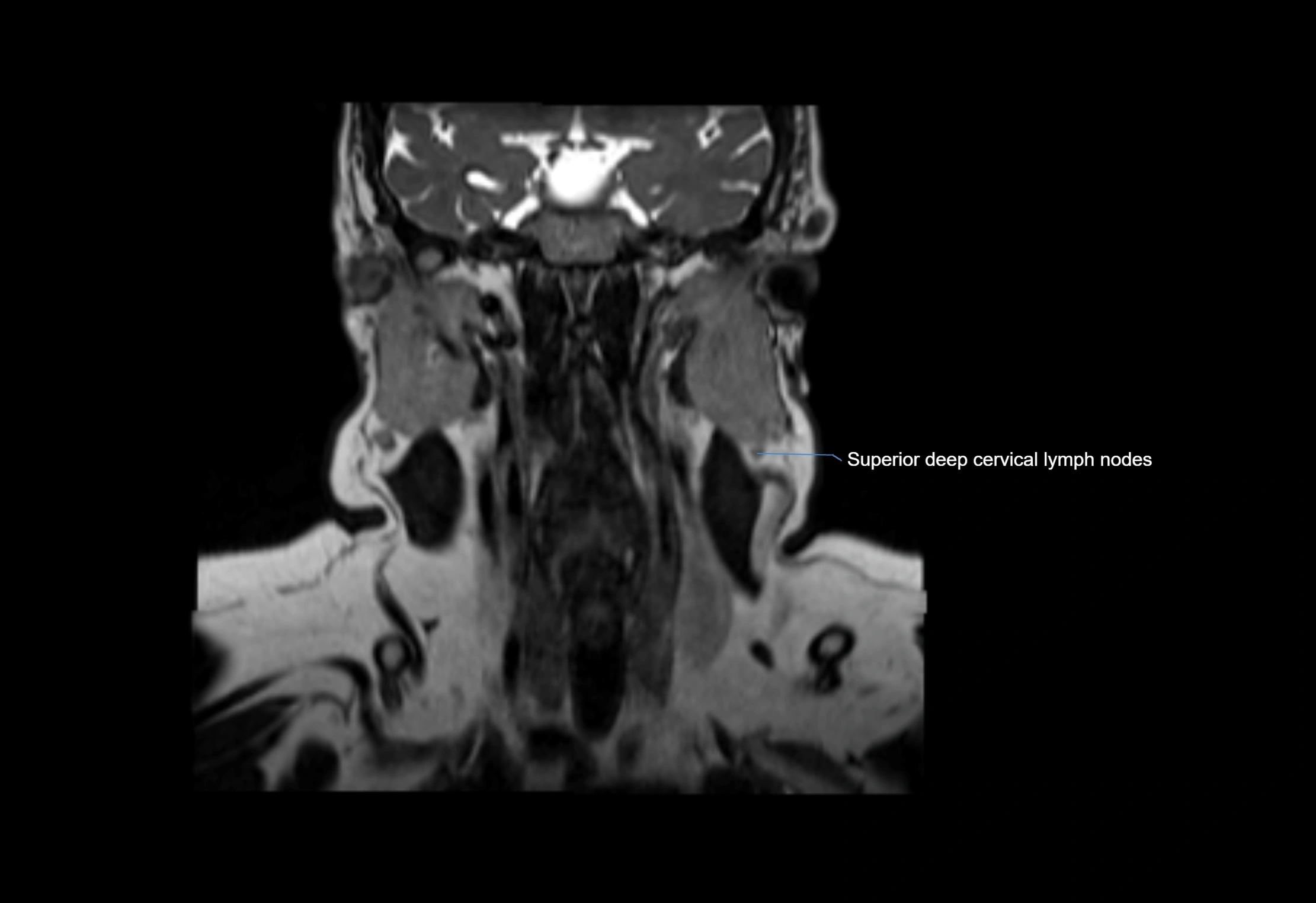 Neck coronal lymph node cross sectional MRI anatomy 3T MRI  image-img-00001-00037.webp